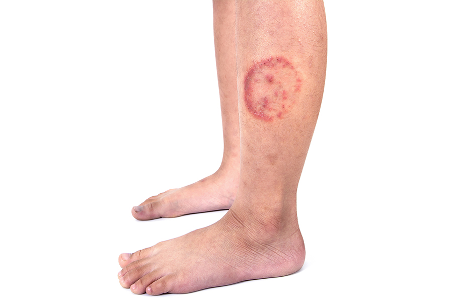 Ayurvedic treatment for ringworm