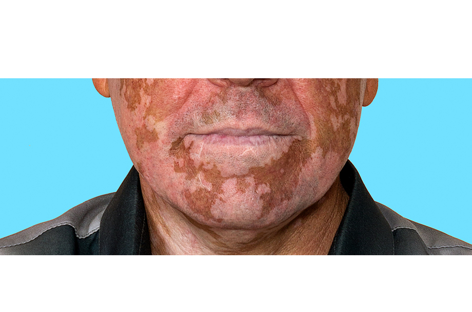 How To Cure Vitiligo Fast Naturally?