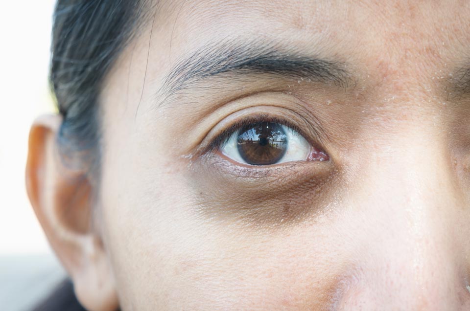 Treating Dark Circles And Wrinkles Around The Eyes With Ayurveda