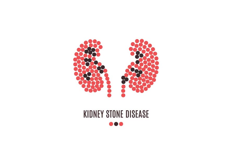 Kidney Stone Causes, Symptoms, Treatments, & Prevention