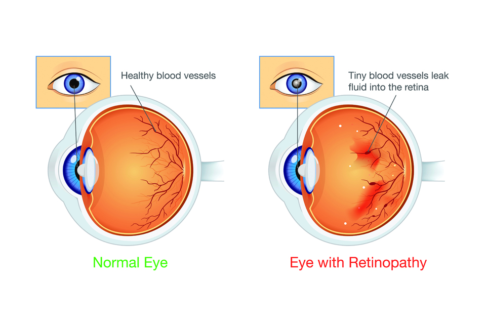 Diabetic Retinopathy - The role of Panchakarma in treatment