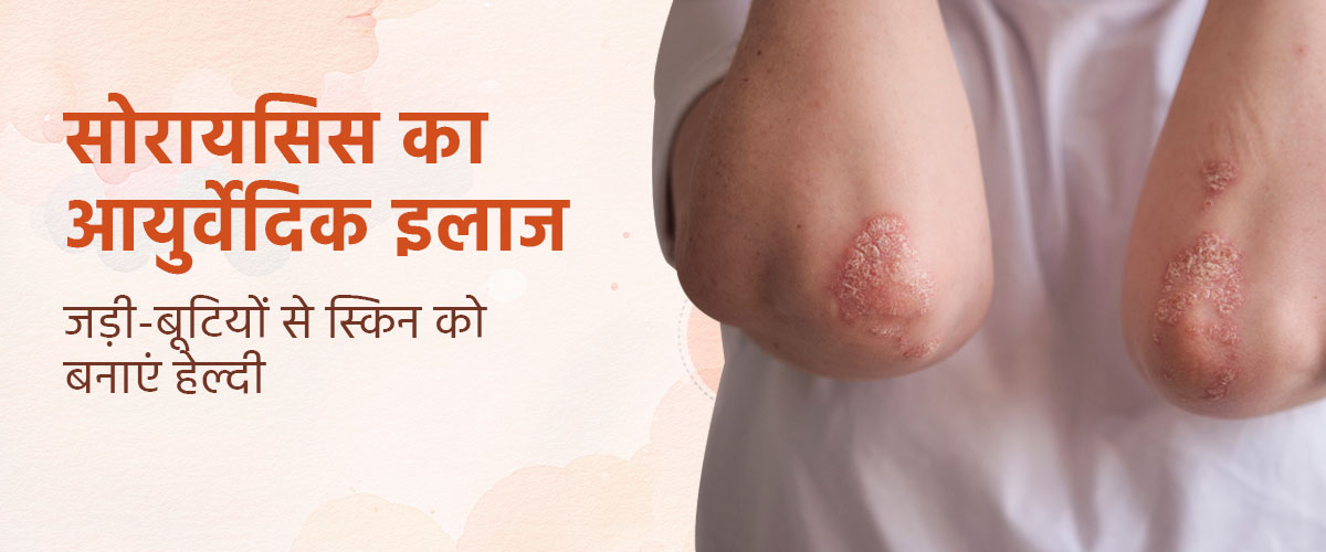 सोरायसिस का आयुर्वेदिक इलाज – जड़ी-बूटियों से स्किन को बनाएं हेल्दी