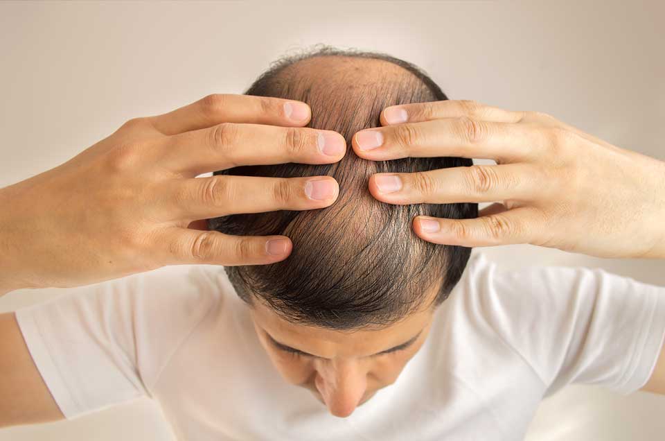 Get Rid of Dandruff, Hair Loss and Premature Graying