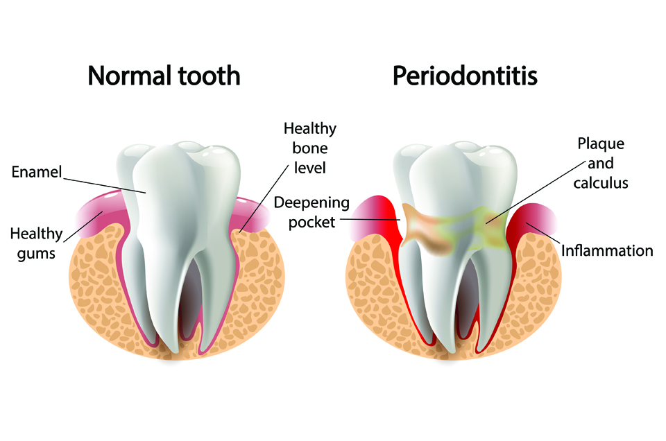 Are Your Pearly White Teeth Under Attack? Build a Strong Defence System with Ayurveda