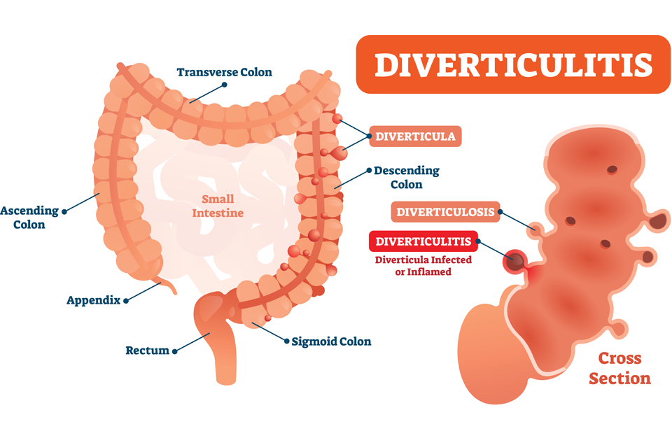 Dietary Advice for Diverticulitis - What to Eat to Manage the Condition