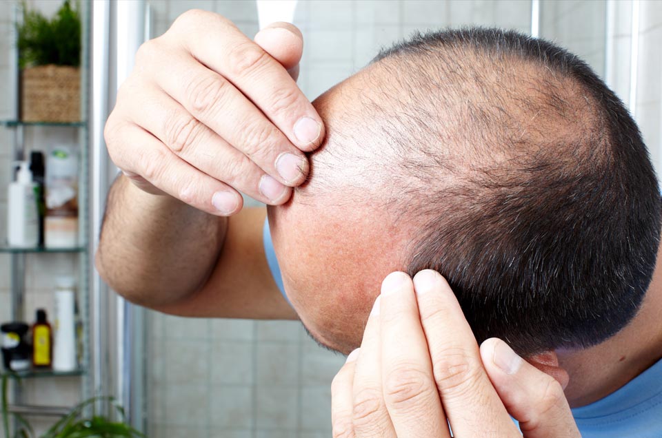 Alopecia and Pattern Baldness: Causes and Preventions