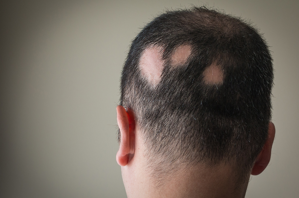 Ayurvedic Treatment For Indralupta (Alopecia)