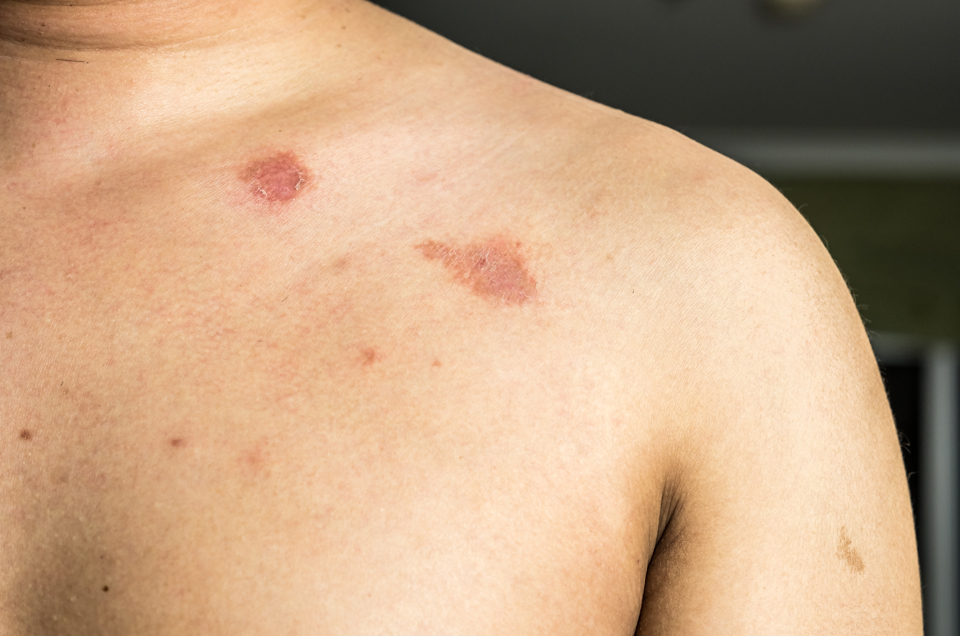 Ringworm ? Understanding types and home remedies