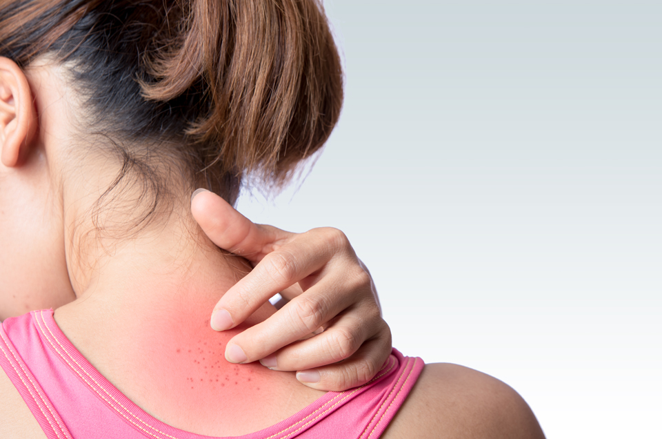 7 very effective home remedies for prickly heat