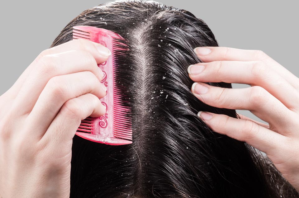 How to Treat Dandruff Effectively With Ayurveda