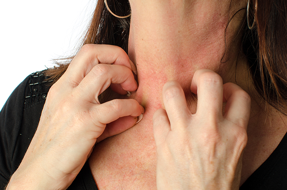 Treat Skin Allergy with Ayurvedic Herbs