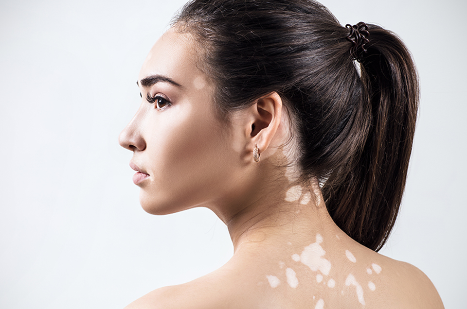 Use Natural Remedies for Relief in Vitiligo with Ayurveda