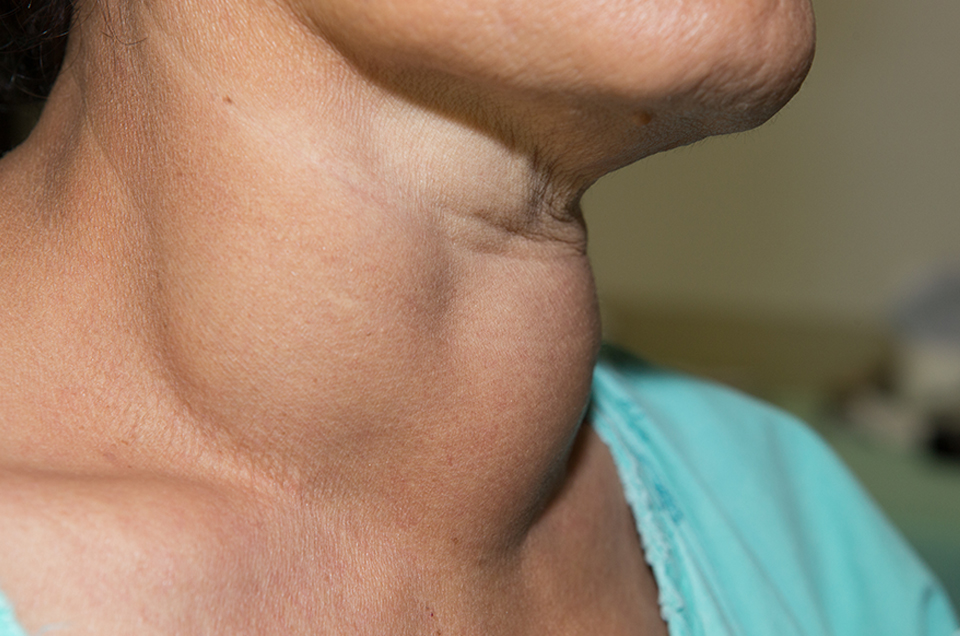 Understand these Thyroid Symptoms for Diagnosis and Treatment