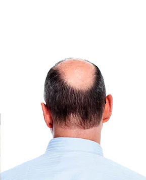 Bald patches